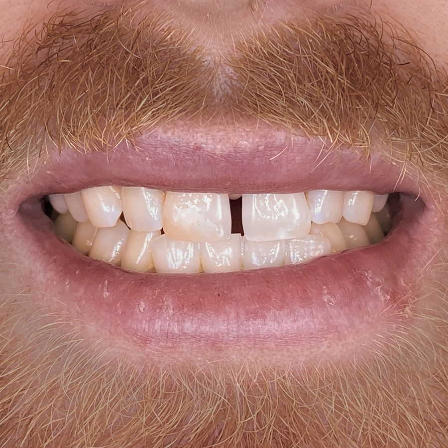 composite bonding - before - smile 13 - 3Dental Dublin & Limerick